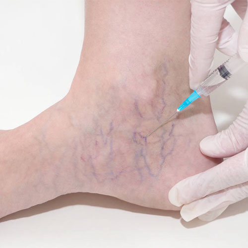 Sclerotherapy-1